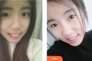 沈陽杏林整形美容醫(yī)院朱石江整形價格表附牙齒矯正案例展示