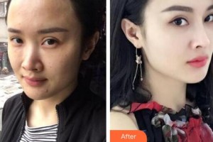 鄂爾多斯百達(dá)麗整形美容醫(yī)院李英春整形價格表附熱瑪吉頸部體驗案例展示