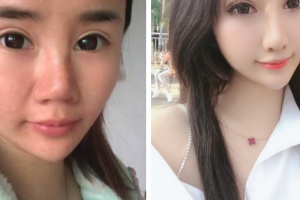 南京友誼整形外科醫(yī)院黃旭培整形價(jià)格表附肋軟骨隆鼻案例展示