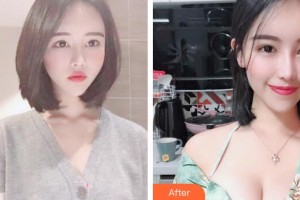 廣州軍美整形醫(yī)院肖強整形價格表附高端定制假體美胸案例展示