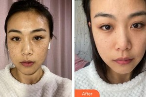 上海宏康醫(yī)院整形美容中心李?lèi)?ài)濤整形價(jià)格表附祛斑日記案例展示