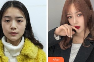 上海玫瑰醫(yī)療美容醫(yī)院黃國(guó)全 整形價(jià)格表附假體隆鼻案例展示