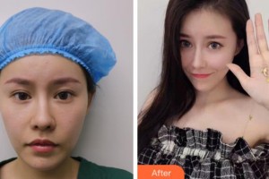 上海玫瑰醫(yī)療美容醫(yī)院尹仁大整形價(jià)格表附假體隆下頦案例展示