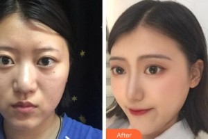 廣州名韓醫(yī)療美容醫(yī)院孫曉捷整形價格表附肋軟骨鼻部手術(shù)案例展示