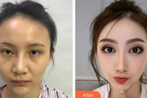 廣州軍區(qū)總醫(yī)院全軍激光整形美容中心彭麗霞整形價格表附鼻部手術(shù)整形案例展示