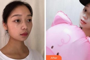 沈陽杏林整形美容醫(yī)院劉建波整形價格表附水氧活膚案例展示