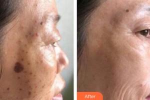 南寧華美整形美容醫(yī)院陳琳整形價格表附激光美膚祛斑案例展示