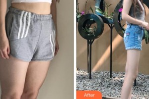 上海華美美萊美容醫(yī)院夏國(guó)興整形價(jià)格表附大腿吸脂案例展示