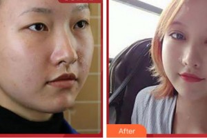 上海玫瑰醫(yī)療美容醫(yī)院金振口整形價(jià)格表附Park法復(fù)式切開(kāi)雙眼皮案例展示