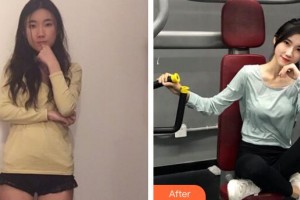 廣州愛來（原阿瑪施）醫(yī)療美容整形醫(yī)院余花整形價格表附玻尿酸導(dǎo)入案例展示