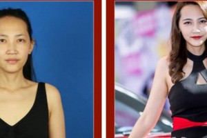 武警上?？傟犪t(yī)院整形美容中心王慕 整形價格表附自體脂肪隆胸案例展示