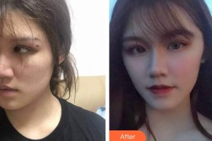 廣州時光整形美容醫(yī)院穆鈺整形價格表附人魚膠提升術(shù)案例展示