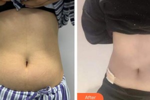 廣州廣美整形美容醫(yī)院李文鋒整形價格表附腰腹吸脂案例展示
