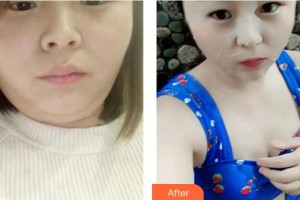 上海美之源整形外科醫(yī)院吳慶貞整形價格表附光子嫩膚案例展示