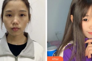 上海閔行區(qū)中醫(yī)院整形外科閆學(xué)敏整形價格表附超激光美膚案例展示