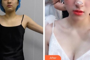 上海藝星醫(yī)療美容醫(yī)院郭仁洙整形價格表附自體脂肪隆胸案例展示