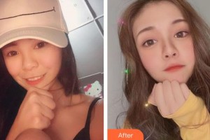 上海紐賽醫(yī)療美容門診部聶嬋整形價格表附玻尿酸導(dǎo)入案例展示