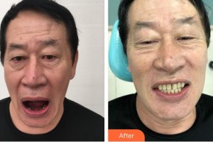 上海伊美爾港華醫(yī)療美容醫(yī)院李功勛整形價格表附種植牙案例展示