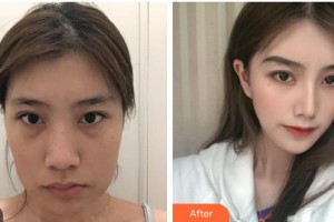 上海港華醫(yī)療美容醫(yī)院黃家海整形價格表附下頜角切除案例展示