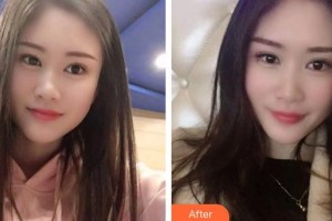 上海富華醫(yī)療美容醫(yī)院余平整形價格表附冷光美白案例展示