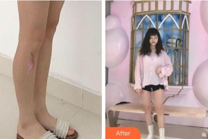 上海港華醫(yī)療美容醫(yī)院周佩整形價格表附增生疤痕案例展示