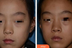 廣州軍頤醫(yī)院整形美容中心曾晶圓整形價(jià)格表附激光點(diǎn)痣案例展示