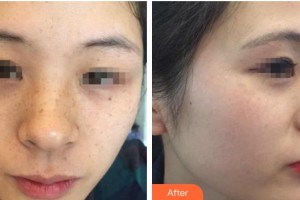 上海港華醫(yī)療美容醫(yī)院汪東華整形價格表附激光祛斑案例展示