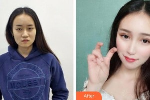 上海比華利整形醫(yī)院李五蘭整形價格表附韓式切開雙眼皮案例展示