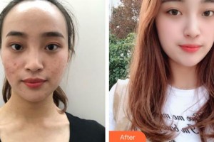 上海比華利整形醫(yī)院陳森 整形價格表附激光去痘案例展示