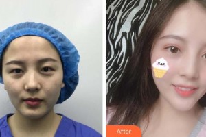 上海茸城女子醫(yī)院整形美容中心金志洙整形價格表附雙眼皮眼部手術案例展示