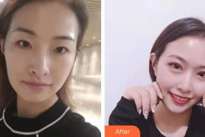 上海瑞麗整形美容醫(yī)院張炫整形價格表附眼部手術案例展示