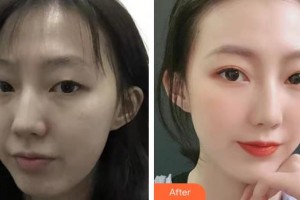 上海吳月蘭整形外科診所侯在恩整形價格表附眼部手術案例展示