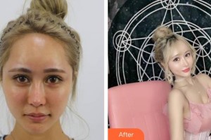 上海辰新醫(yī)院醫(yī)學美容科楊希鏸整形價格表附酒窩案例展示