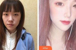 民航上海醫(yī)院整形外科莫建明整形價格表附美鼻部手術案例展示