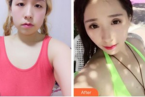 民航上海醫(yī)院整形外科俞良鋼整形價格表附假體隆胸整形案例展示