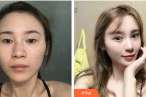 上?，旣愥t(yī)院整形美容中心謝宏德整形價格表附切開雙眼皮案例展示