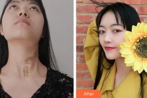 上海交通大學附屬瑞金醫(yī)院燒傷整形科董鶴亮整形價格表附燙傷疤痕修復案例展示