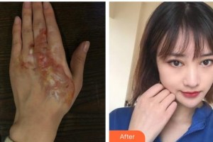 上海交通大學附屬瑞金醫(yī)院燒傷整形科方培耀整形價格表附燙傷疤痕案例展示