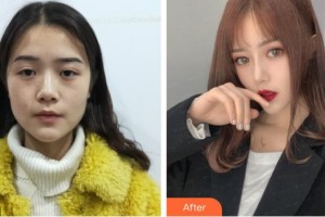 上海復旦大學附屬華山醫(yī)院整形外科丁偉整形價格表附美鼻部手術(shù)案例展示