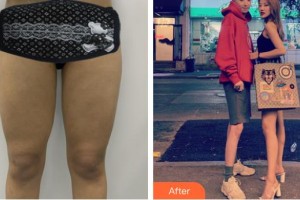 上海復旦大學附屬華山醫(yī)院整形外科周兆平整形價格表附大腿吸脂案例展示