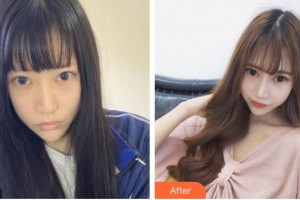 上海市第一人民醫(yī)院整形外科賈萬新整形價格表附面部吸脂案例展示