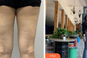 上海第二軍醫(yī)大學附屬長征醫(yī)院整形外科朱曉海整形價格表附大腿吸脂案例展示