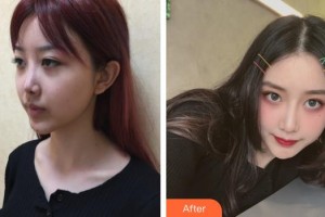 上海第二軍醫(yī)大學附屬長海醫(yī)院整形外科薛春雨整形價格表附墊鼻梁雕刻鼻尖案例展示