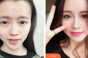 上海第二軍醫(yī)大學附屬長海醫(yī)院整形外科郭恩覃整形價格表附面部填充案例展示