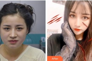 煙臺華怡醫(yī)學美容醫(yī)院張上海整形價格表附面部光纖案例展示