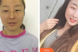 上海華美醫(yī)療美容醫(yī)院武崇高整形價格表附祛眼袋案例展示