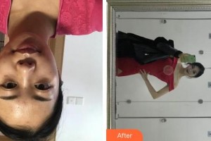 上海第八人民醫(yī)院美容整形科陳煒整形價格表附隆鼻案例展示