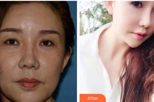 上海原辰醫(yī)療美容醫(yī)院黃仁錫整形價格表附眼部整形案例展示