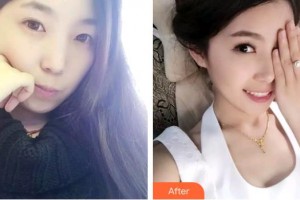 上海常亮醫(yī)療美容診所蔣春梅整形價格表附提眉術案例展示