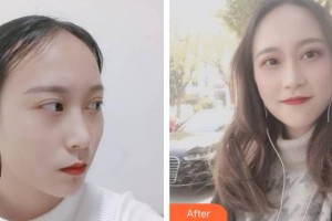上海解放軍第四五五醫(yī)院激光整形科李宇飛整形價格表附女性發(fā)際線種植案例展示